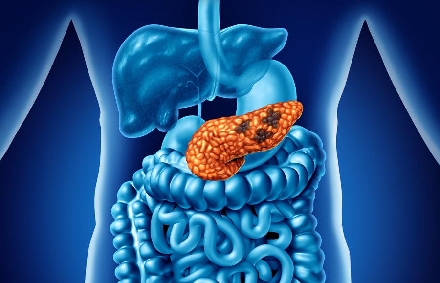 New Oral Medication Shows Promise in Pancreatic Cancer Treatment