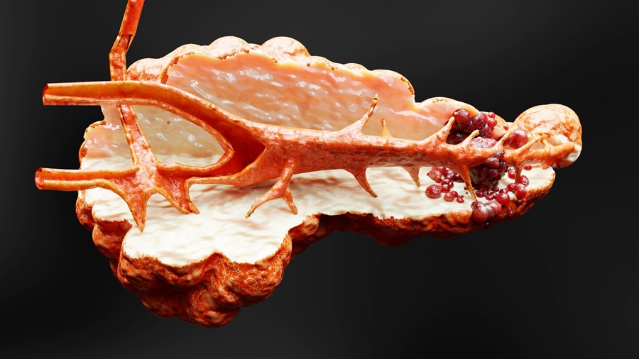 cancerous pancreas