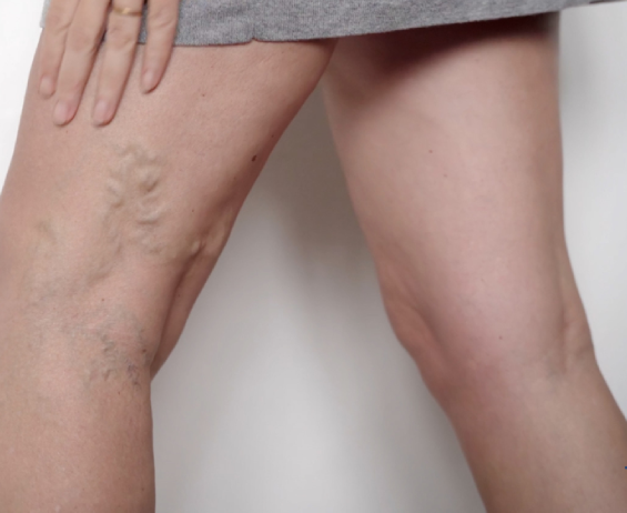 When to Seek Treatment for Varicose Veins