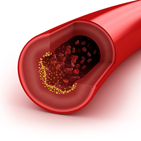 Protect Yourself From Carotid Artery Disease