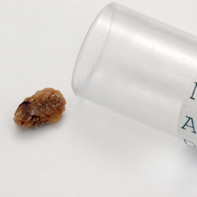 Can You Wait to Treat Kidney Stones?