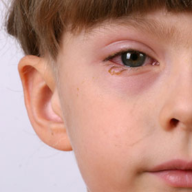 How to Treat Pink Eye and Other Viruses
