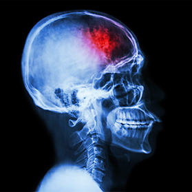 Febrile Seizures: What You Need to Know