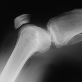 Do I Need Arthroscopic Knee Surgery?
