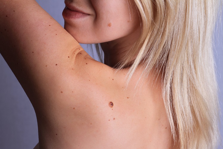 Know Your Moles: Tips for Informed and Healthy Skin Care
