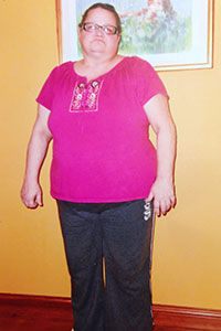 before weight loss surgery