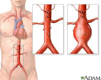 ADAM_aortic_aneurysm_200x