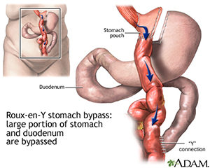 Laparoscopic Gastric Bypass-ADAM