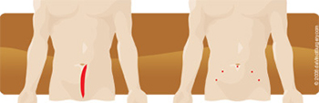 bladder cancer robotic-assisted cystectomy
