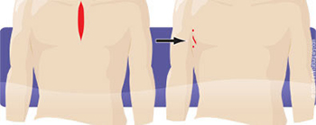 Lung Cancer incision comparison