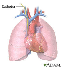 ADAM_-_catheter_ablation_200x