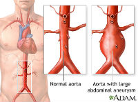 ADAM_-_aortic_aneurysm_200x