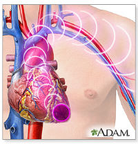 ADAM_-_heart_attack_symptoms_200x1