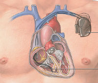 ADAM_-_implantable_cardiac_defibrillator_200x