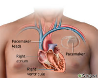 ADAM_-_pacemaker_200x