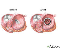 ADAM_-_heart_valve_surgery_200x