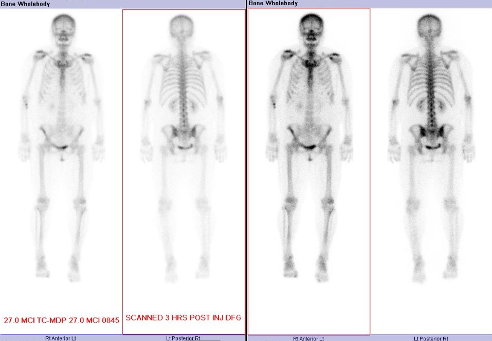 Nuclear Medicine Whole Body Scan Image