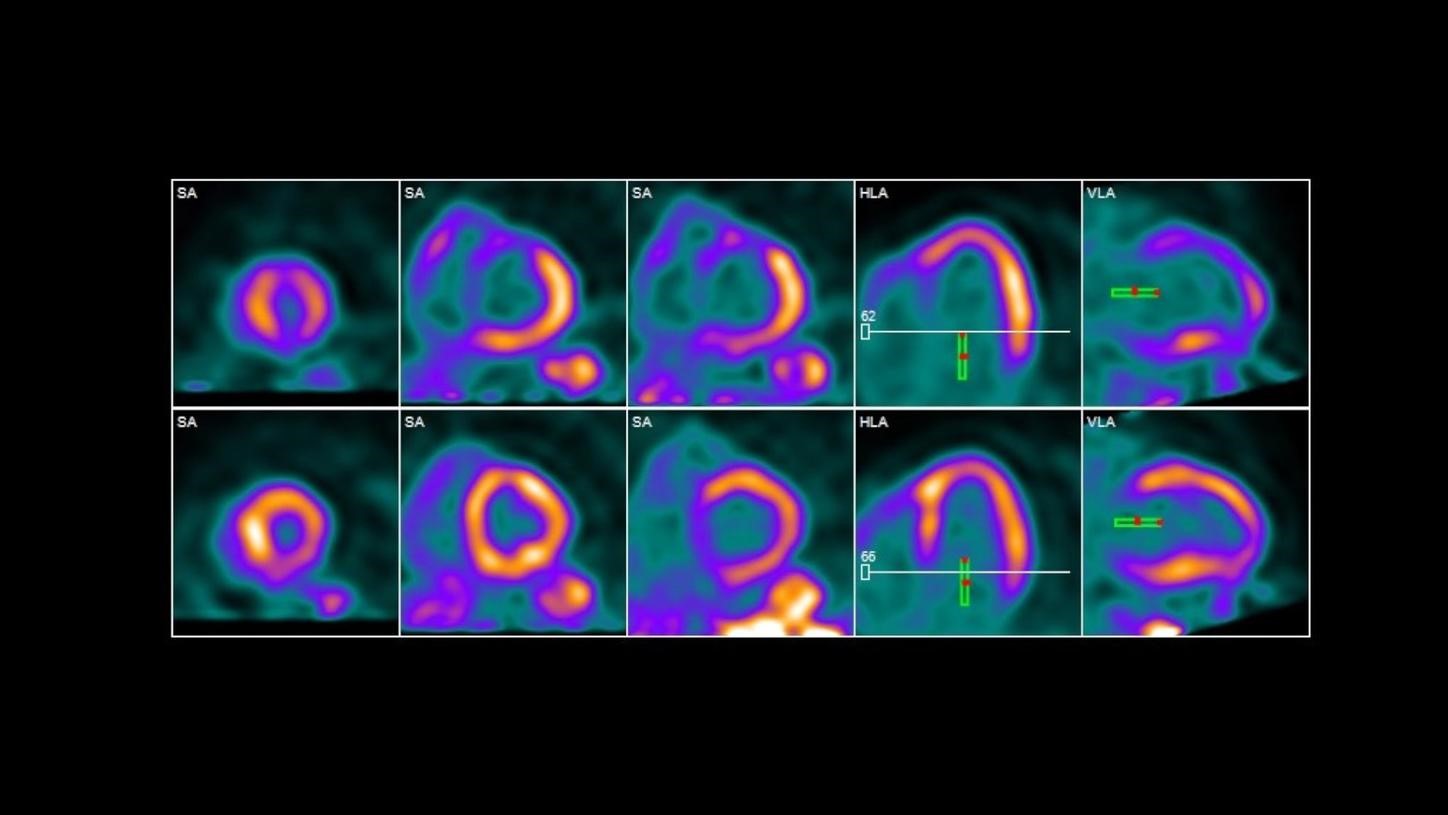 Cardiac PET Scan