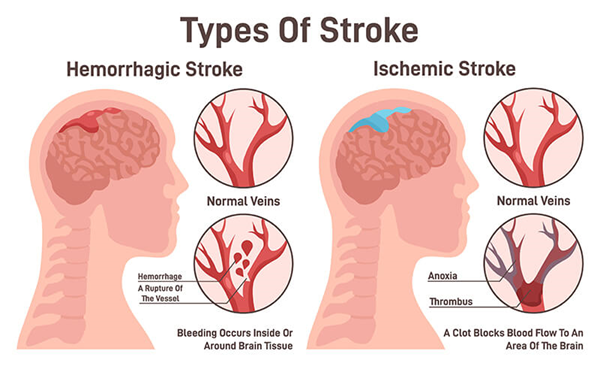 Types of stroke