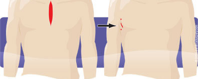 Mitral Valve Repair Comparison