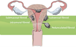 Uterine Fibroids