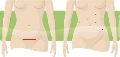 Incision comparison for traditional and robotic-assisted hysterectomy