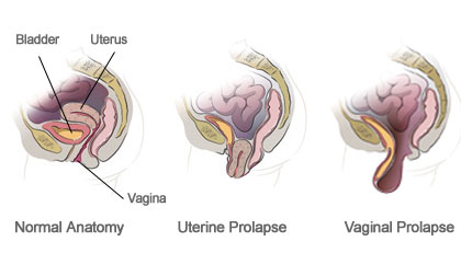Vaginal prolapse: Causes and treatment options