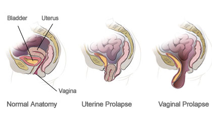 Uterus Prolapse Treatment