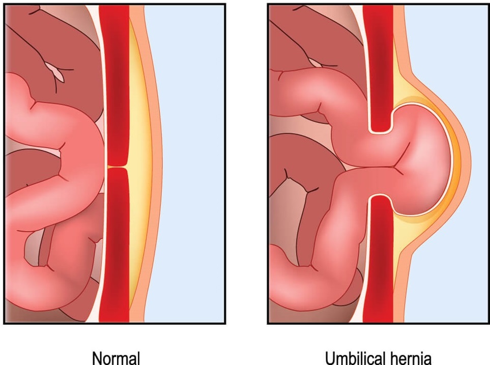 umbilical hernia illustration
