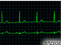 ADAM_-_heart_conditions_-_bradycardia_200x