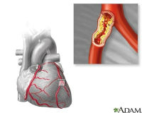 ADAM_-_heart_conditions_-_atherosclerosis_200x