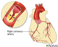 ADAM_-_heart_conditions_-_coronary_artery_disease_200x