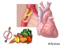 ADAM_-_heart_conditions_-_heart_disease_200x
