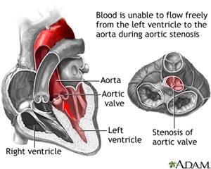 Aortic Stenosis Bascilica
