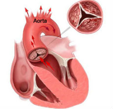 aortic_stenosis_230x