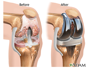 Knee Joint Replacement: Before and After