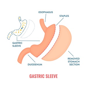 laproscopic-sleeve