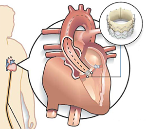 Transcatheter Aortic Valve Replacement - TAVR